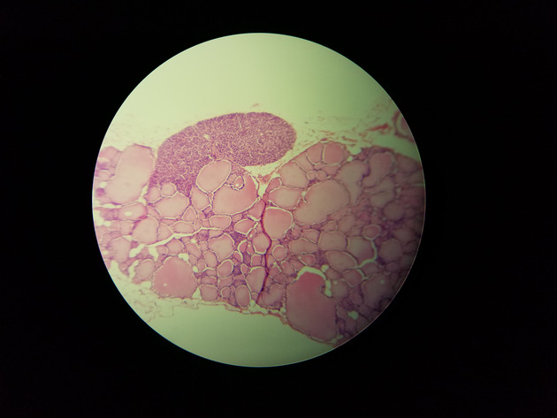 Parathyroid Thyroid Slides - Parathyroid_Thyroid 004 100X